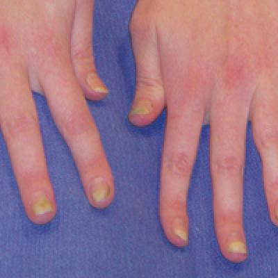 Bilateral Symmetric Onycholysis of Distal Fingernails | MDedge Dermatology