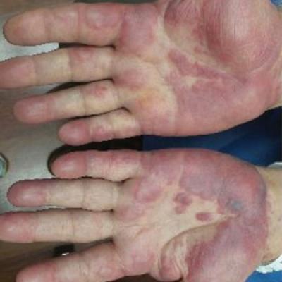 Sweet Syndrome With Marked Eosinophilic Infiltrate | MDedge Dermatology