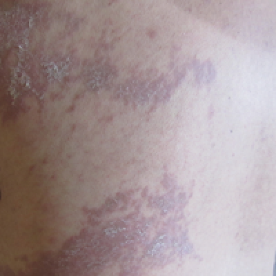 Graft-versus-host Disease Presenting Along Blaschko Lines: Cutaneous ...