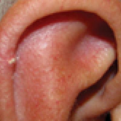 Gouty Tophi on the Ear: A Review | MDedge Dermatology