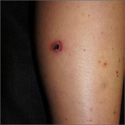 Rash on legs and abdomen | MDedge Family Medicine
