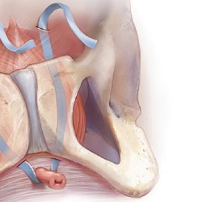 Using slings for the surgical management of urinary incontinence: A ...